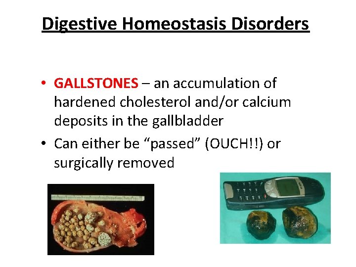 Digestive Homeostasis Disorders • GALLSTONES – an accumulation of hardened cholesterol and/or calcium deposits Digestive Homeostasis Disorders • GALLSTONES – an accumulation of hardened cholesterol and/or calcium deposits
