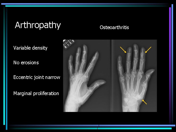 Arthropathy Variable density No erosions Eccentric joint narrow Marginal proliferation Osteoarthritis 