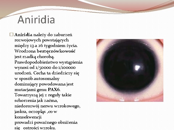 Aniridia � Aniridia należy do zaburzeń rozwojowych powstających między 13 a 26 tygodniem życia.