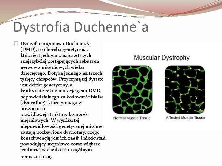 Dystrofia Duchenne`a � Dystrofia mięśniowa Duchenne'a (DMD), to choroba genetyczna, która jest jednym z