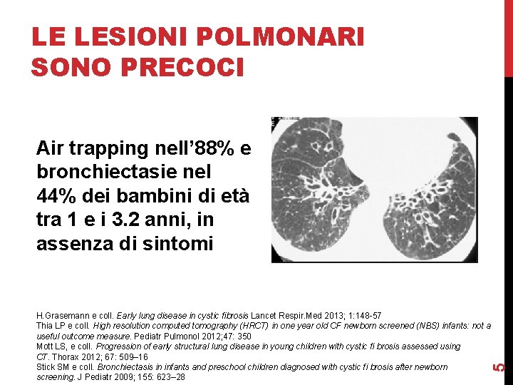 LE LESIONI POLMONARI SONO PRECOCI Air trapping nell’ 88% e bronchiectasie nel 44% dei LE LESIONI POLMONARI SONO PRECOCI Air trapping nell’ 88% e bronchiectasie nel 44% dei
