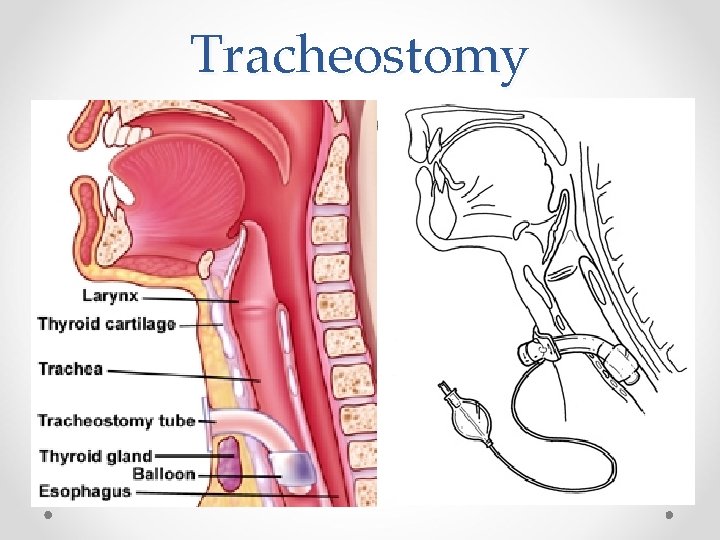 Tracheostomy 