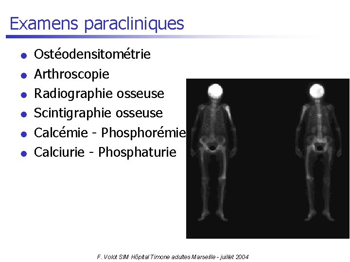 Examens paracliniques l l l Ostéodensitométrie Arthroscopie Radiographie osseuse Scintigraphie osseuse Calcémie - Phosphorémie