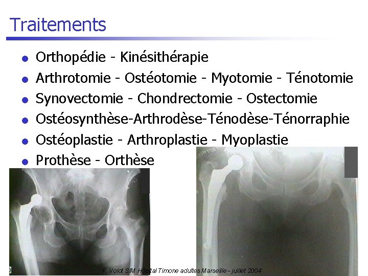 Traitements l l l Orthopédie - Kinésithérapie Arthrotomie - Ostéotomie - Myotomie - Ténotomie