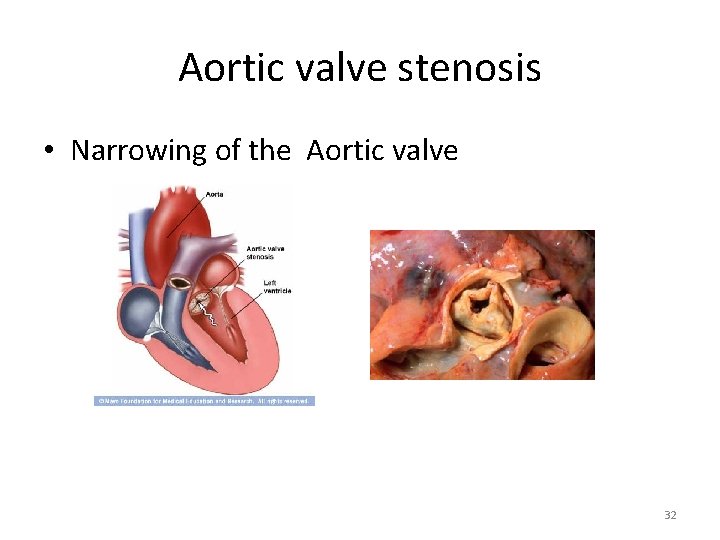 Aortic valve stenosis • Narrowing of the Aortic valve 32 