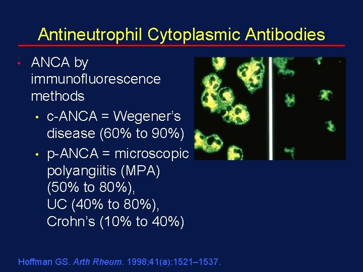 Antineutrophil Cytoplasmic Antibodies • ANCA by immunofluorescence methods • c-ANCA = Wegener’s disease (60%