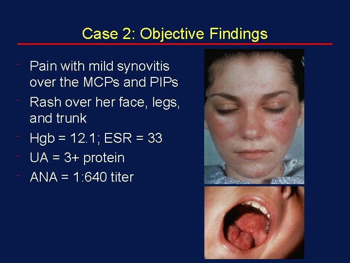 Case 2: Objective Findings ˜ ˜ ˜ Pain with mild synovitis over the MCPs