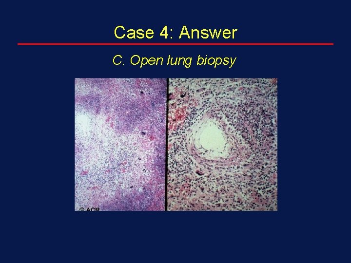 Case 4: Answer C. Open lung biopsy 