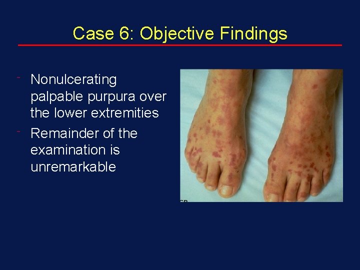 Case 6: Objective Findings ˜ ˜ Nonulcerating palpable purpura over the lower extremities Remainder