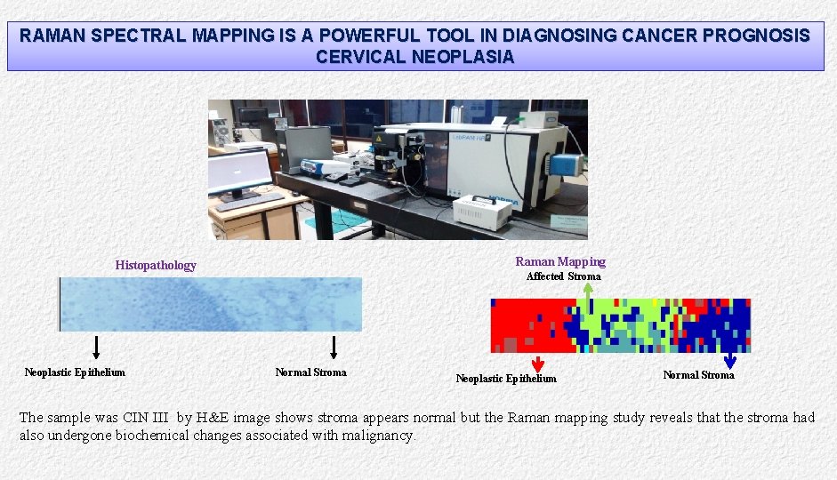 RAMAN SPECTRAL MAPPING IS A POWERFUL TOOL IN DIAGNOSING CANCER PROGNOSIS CERVICAL NEOPLASIA Raman
