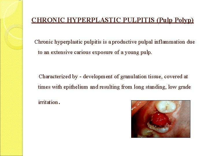 CHRONIC HYPERPLASTIC PULPITIS (Pulp Polyp) Chronic hyperplastic pulpitis is a productive pulpal inflammation due CHRONIC HYPERPLASTIC PULPITIS (Pulp Polyp) Chronic hyperplastic pulpitis is a productive pulpal inflammation due