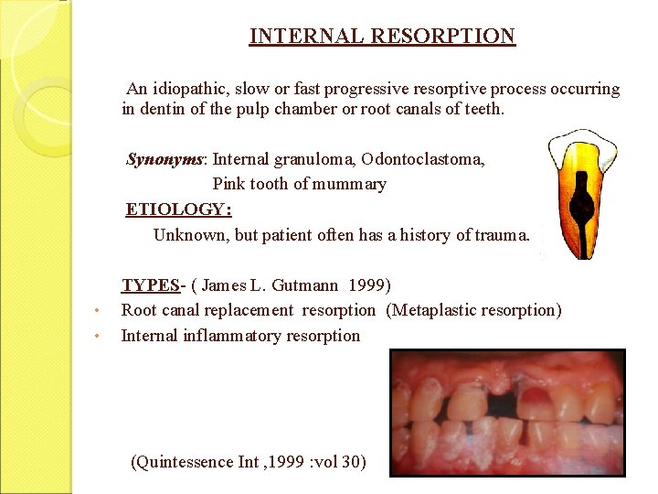 INTERNAL RESORPTION An idiopathic, slow or fast progressive resorptive process occurring in dentin of