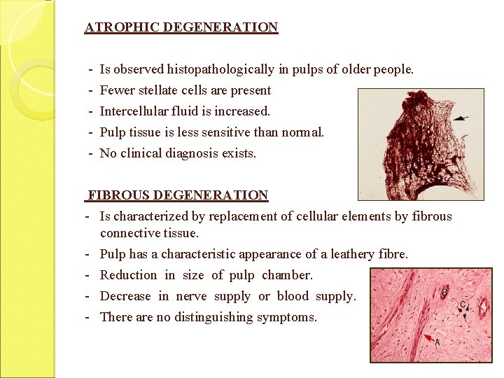 ATROPHIC DEGENERATION - Is observed histopathologically in pulps of older people. - Fewer stellate
