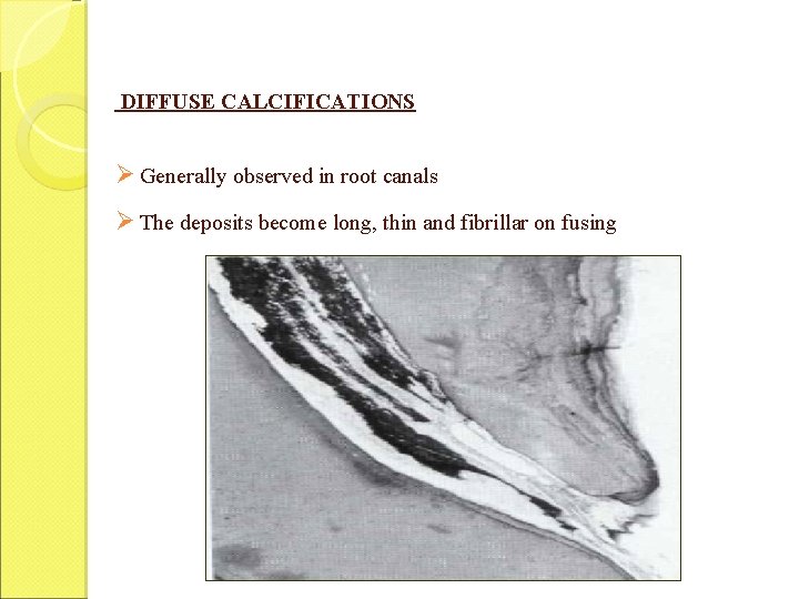 DIFFUSE CALCIFICATIONS Ø Generally observed in root canals Ø The deposits become long, thin