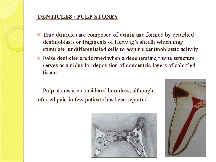 DENTICLES / PULP STONES v True denticles are composed of dentin and formed by