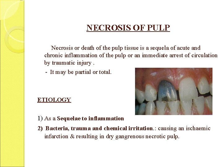 NECROSIS OF PULP Necrosis or death of the pulp tissue is a sequela of