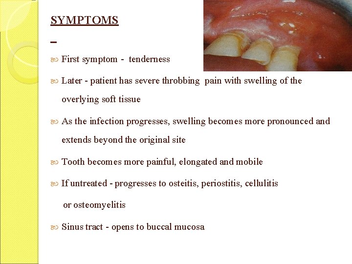 SYMPTOMS First symptom - tenderness Later - patient has severe throbbing pain with swelling SYMPTOMS First symptom - tenderness Later - patient has severe throbbing pain with swelling
