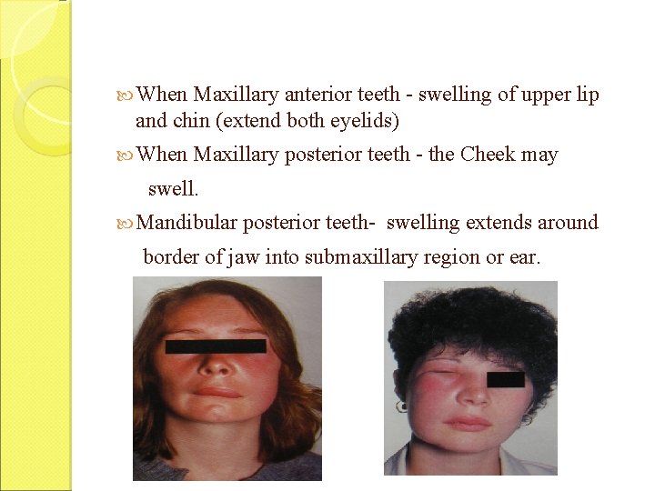  When Maxillary anterior teeth - swelling of upper lip and chin (extend both