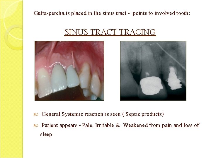 Gutta-percha is placed in the sinus tract - points to involved tooth: SINUS TRACT