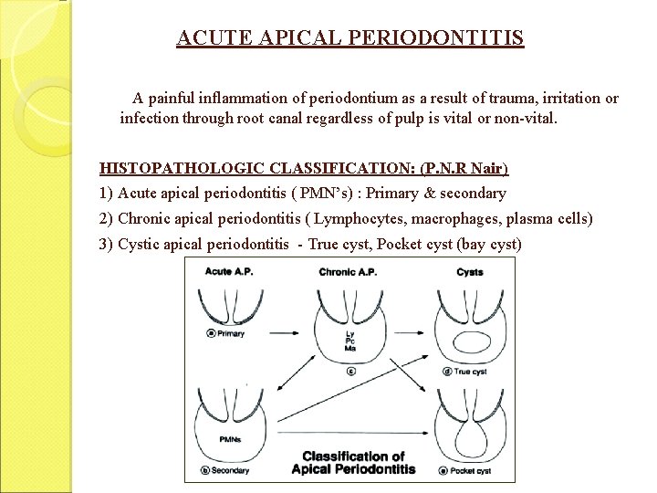 ACUTE APICAL PERIODONTITIS A painful inflammation of periodontium as a result of trauma, irritation