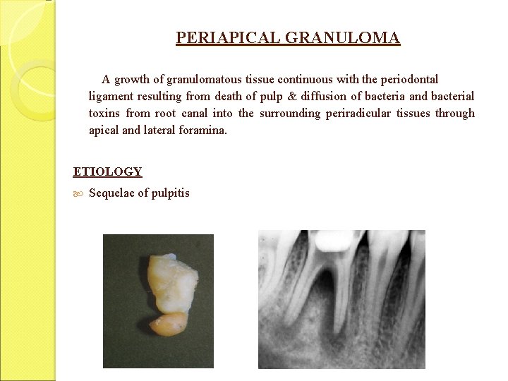 PERIAPICAL GRANULOMA A growth of granulomatous tissue continuous with the periodontal ligament resulting from