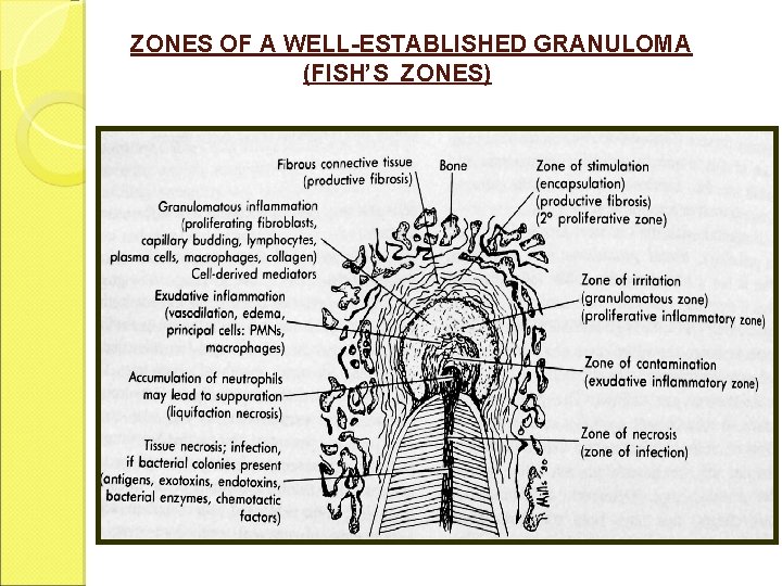 ZONES OF A WELL-ESTABLISHED GRANULOMA (FISH’S ZONES) 