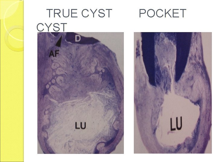 TRUE CYST POCKET TRUE CYST POCKET