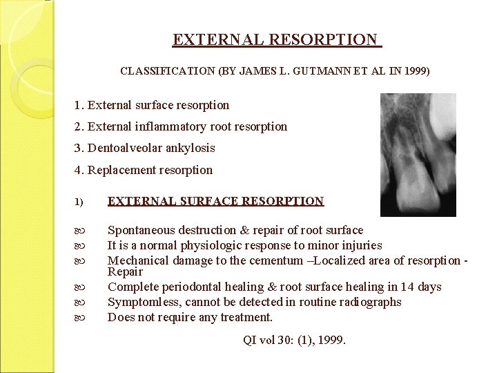 EXTERNAL RESORPTION CLASSIFICATION (BY JAMES L. GUTMANN ET AL IN 1999) 1. External surface