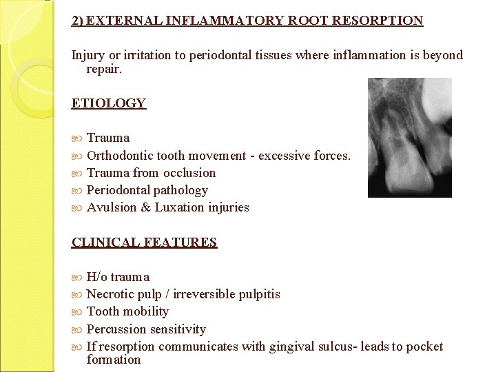 2) EXTERNAL INFLAMMATORY ROOT RESORPTION Injury or irritation to periodontal tissues where inflammation is