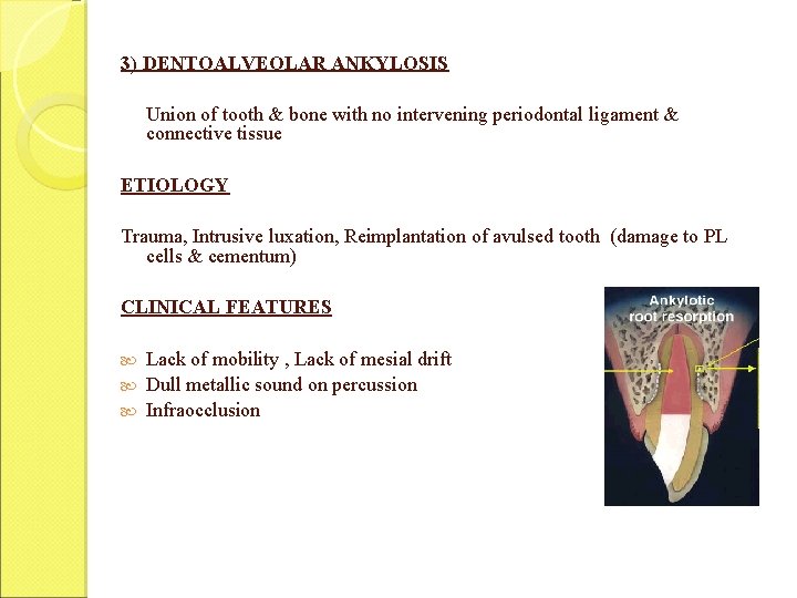 3) DENTOALVEOLAR ANKYLOSIS Union of tooth & bone with no intervening periodontal ligament &