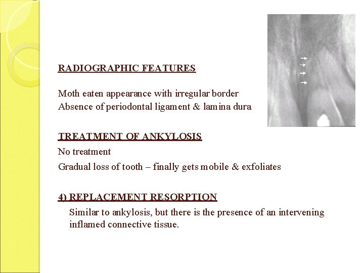 RADIOGRAPHIC FEATURES Moth eaten appearance with irregular border Absence of periodontal ligament & lamina