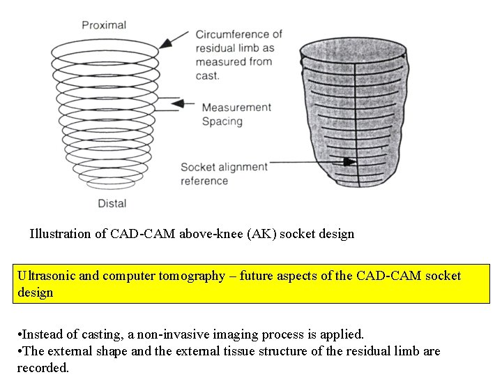 Illustration of CAD-CAM above-knee (AK) socket design Ultrasonic and computer tomography – future aspects