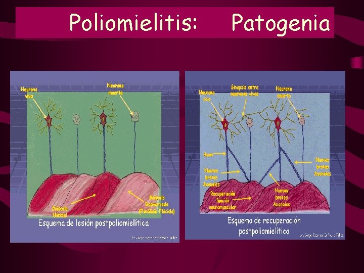Poliomielitis: Patogenia Poliomielitis: Patogenia