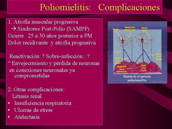 Poliomielitis: Complicaciones 1. Atrofia muscular progresiva Sindrome Post-Polio (SAMPP) Ocurre 25 a 30 años Poliomielitis: Complicaciones 1. Atrofia muscular progresiva Sindrome Post-Polio (SAMPP) Ocurre 25 a 30 años