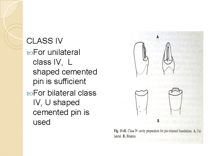 CLASS IV For unilateral class IV, L shaped cemented pin is sufficient For bilateral