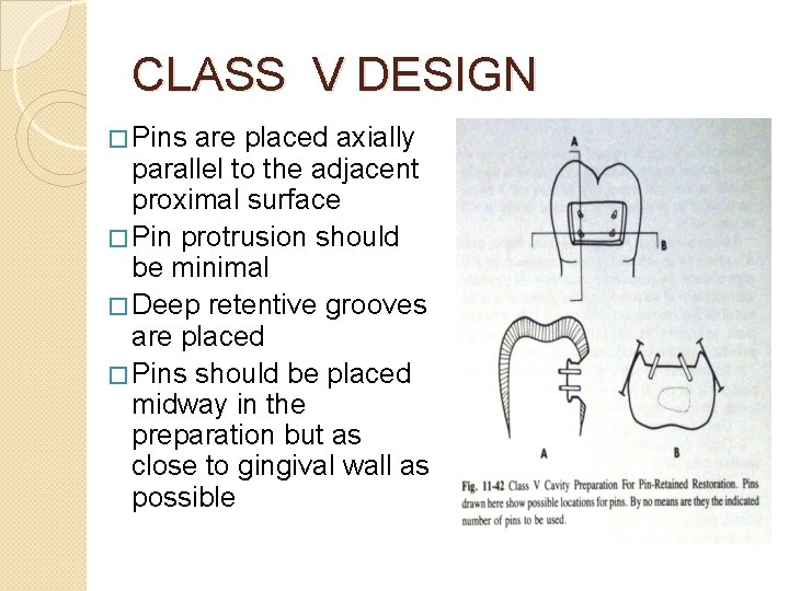 CLASS V DESIGN � Pins are placed axially parallel to the adjacent proximal surface