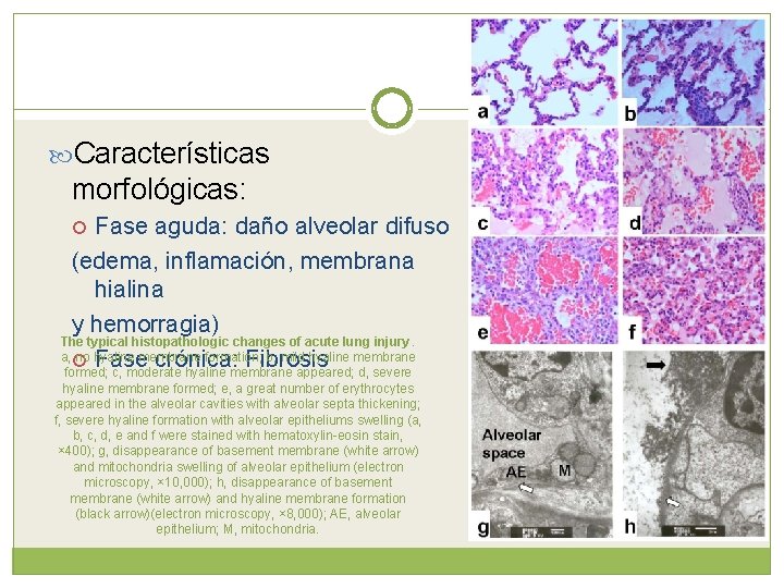  Características morfológicas: Fase aguda: daño alveolar difuso (edema, inflamación, membrana hialina y hemorragia)