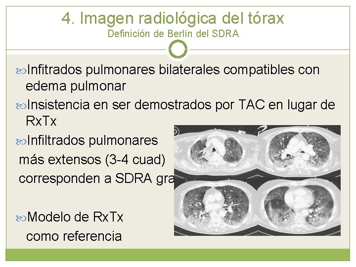 4. Imagen radiológica del tórax Definición de Berlín del SDRA Infitrados pulmonares bilaterales compatibles