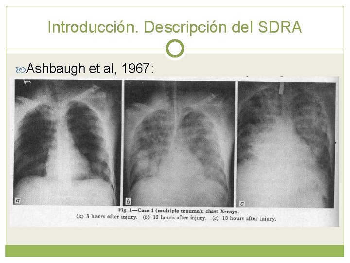 Introducción. Descripción del SDRA Ashbaugh et al, 1967: Identifica 12 pacientes que no responden