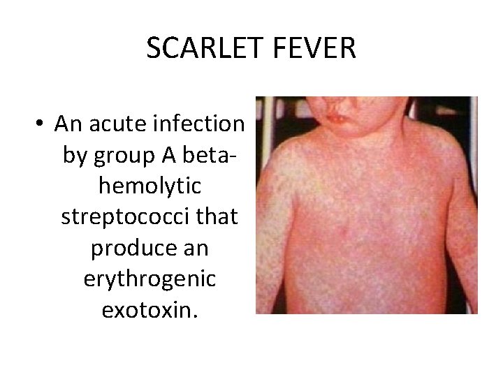 SCARLET FEVER • An acute infection by group A betahemolytic streptococci that produce an