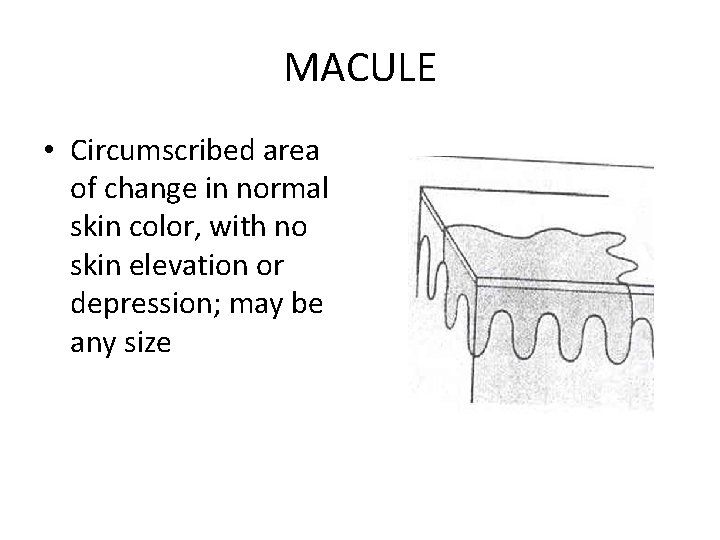 MACULE • Circumscribed area of change in normal skin color, with no skin elevation