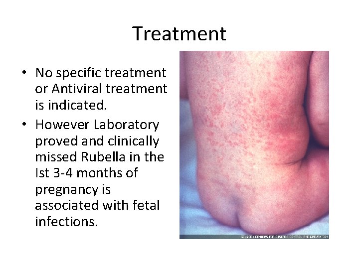 Treatment • No specific treatment or Antiviral treatment is indicated. • However Laboratory proved