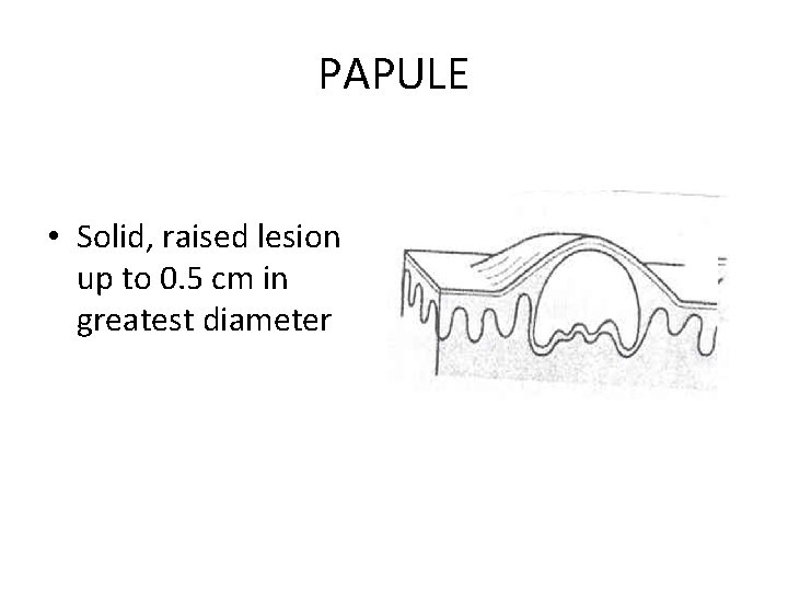 PAPULE • Solid, raised lesion up to 0. 5 cm in greatest diameter 