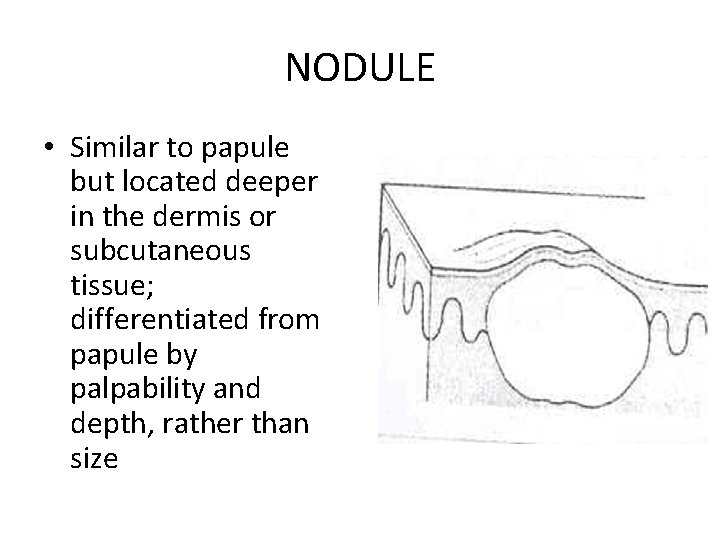 NODULE • Similar to papule but located deeper in the dermis or subcutaneous tissue;