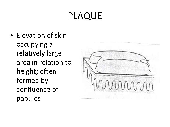 PLAQUE • Elevation of skin occupying a relatively large area in relation to height;