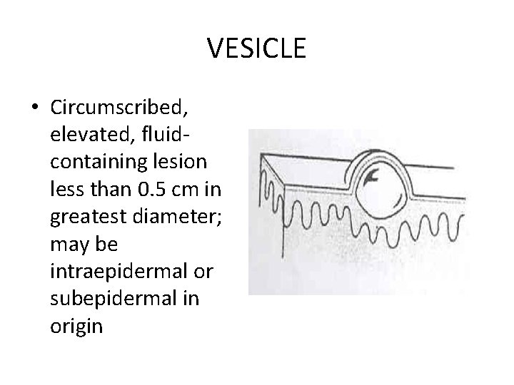 VESICLE • Circumscribed, elevated, fluidcontaining lesion less than 0. 5 cm in greatest diameter;