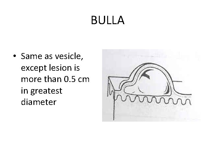 BULLA • Same as vesicle, except lesion is more than 0. 5 cm in