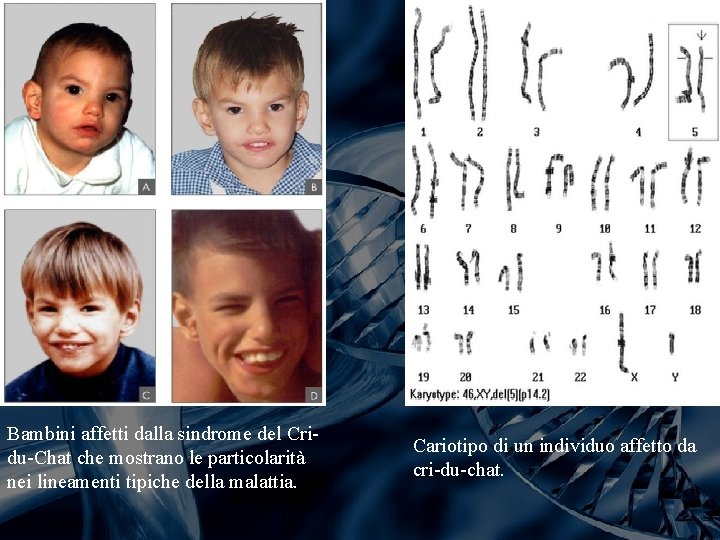 Bambini affetti dalla sindrome del Cridu-Chat che mostrano le particolarità nei lineamenti tipiche della Bambini affetti dalla sindrome del Cridu-Chat che mostrano le particolarità nei lineamenti tipiche della