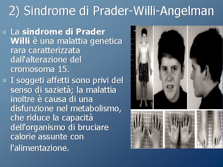 2) Sindrome di Prader-Willi-Angelman n n La sindrome di Prader Willi è una malattia 2) Sindrome di Prader-Willi-Angelman n n La sindrome di Prader Willi è una malattia