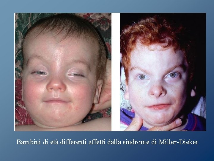 Bambini di età differenti affetti dalla sindrome di Miller-Dieker Bambini di età differenti affetti dalla sindrome di Miller-Dieker